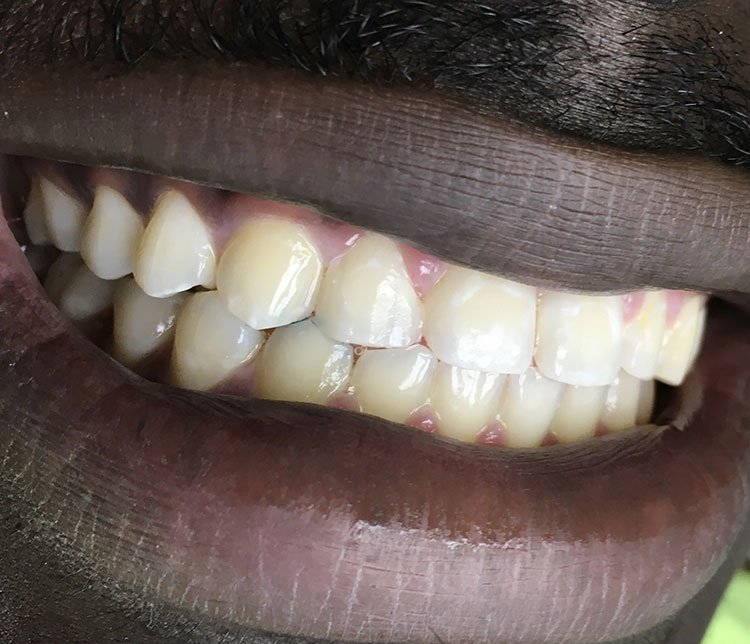 Smile after bonding