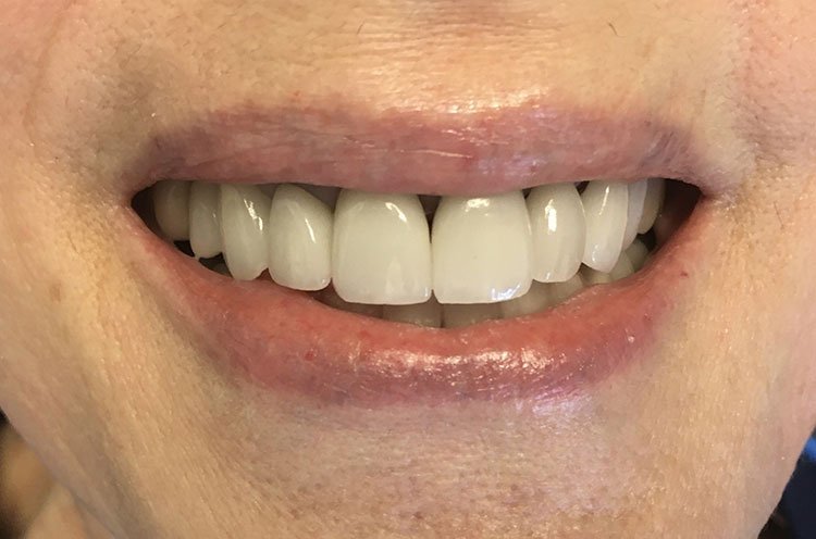 Smile after crowns and veneers