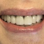 Smile after crowns and veneers