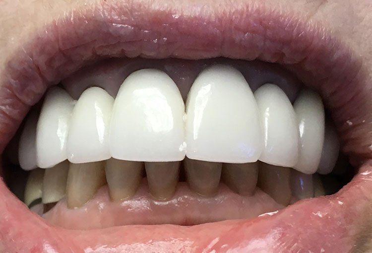 Smile before crowns and veneers