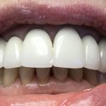 Smile before crowns and veneers