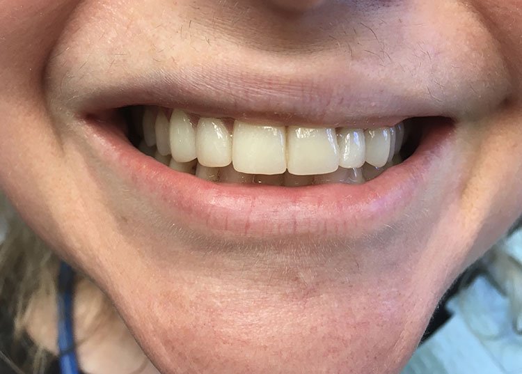Smile after crowns and veneers