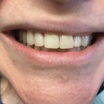 Smile after crowns and veneers