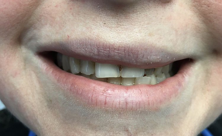 Smile before crowns and veneers