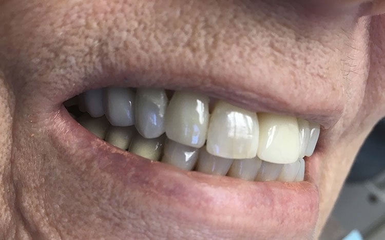 Smile after crowns and veneers