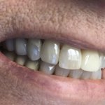 Smile after crowns and veneers
