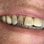 Smile before crowns and veneers