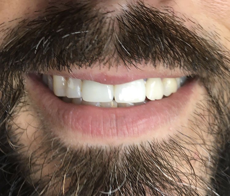 Smile after crowns and veneers