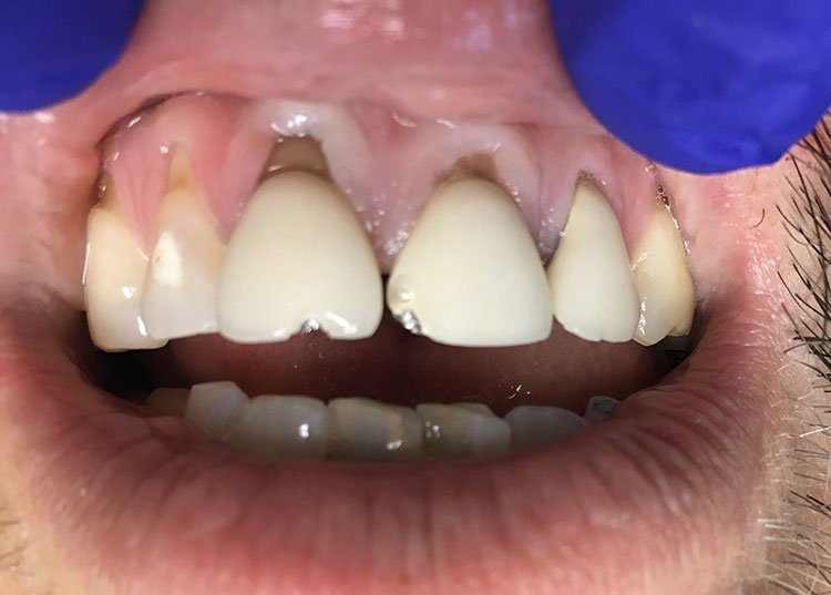 Smile before crowns and veneers