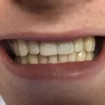 Smile after crowns and veneers, fixed tooth