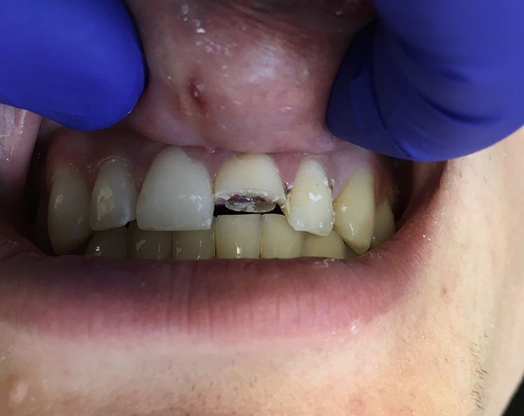 Smile before crowns and veneers, broken tooth