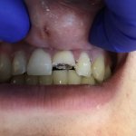 Smile before crowns and veneers, broken tooth