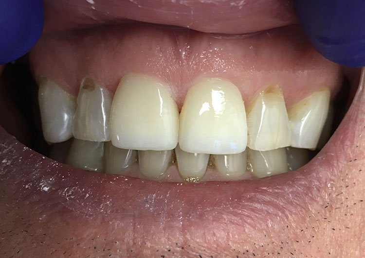 Smile after crowns and veneers