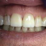 Smile after crowns and veneers