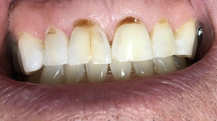 Smile before crowns and veneers