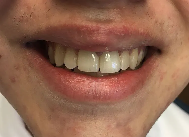 Smile after crowns and veneers, fixed teeth