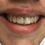 Smile after crowns and veneers, fixed teeth