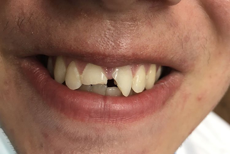 Smile before crowns and veneers, broken front teeth