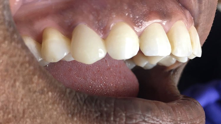 Smile after crowns and veneers