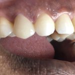 Smile after crowns and veneers