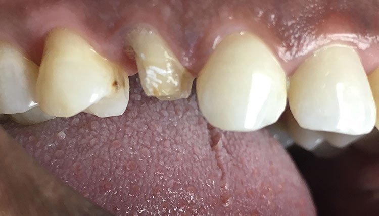 Smile before crowns and veneers