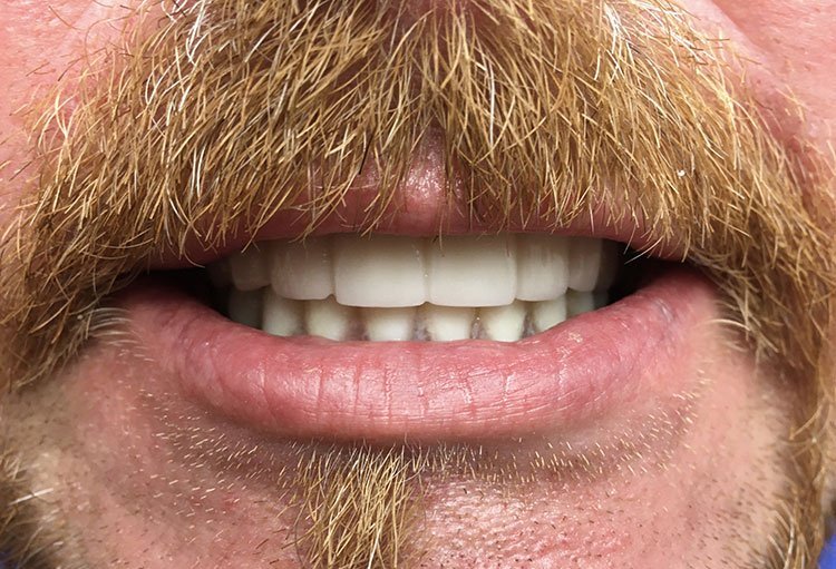 Smile before Full Mouth Hybrid