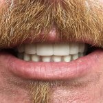 Smile before Full Mouth Hybrid