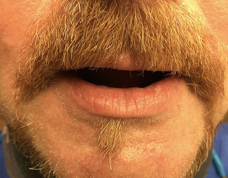 Smile before Full Mouth Hybrid