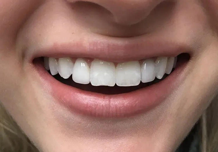 Smile after Dental Implants