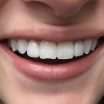 Smile after Dental Implants