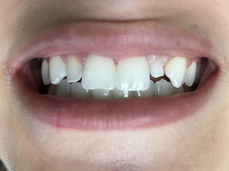Smile before Dental Implants