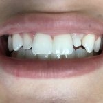Smile before Dental Implants