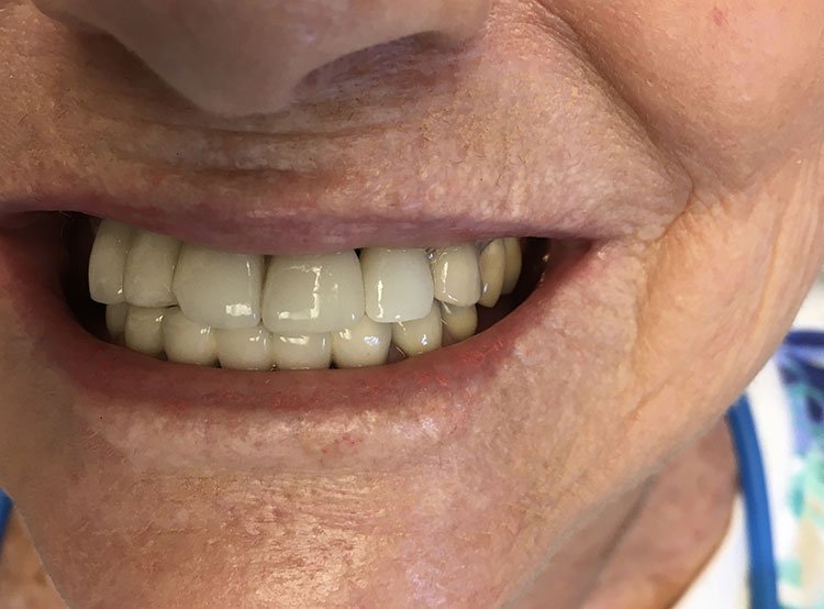 Smile after Dental Implants