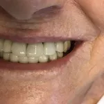 Smile after Dental Implants
