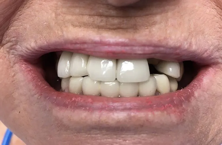 Smile before Dental Implants