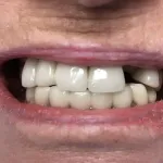 Smile before Dental Implants