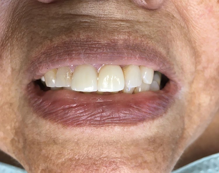 Smile after Dental Implants