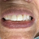 Smile after Dental Implants