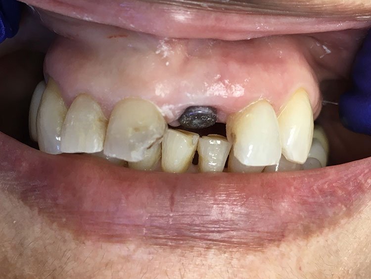 Smile before Dental Implants