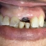 Smile before Dental Implants
