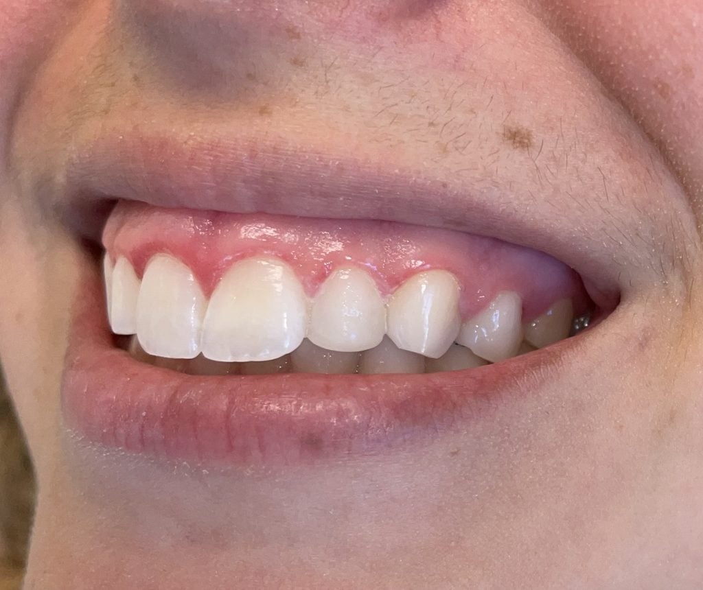 After Dental Bonding
