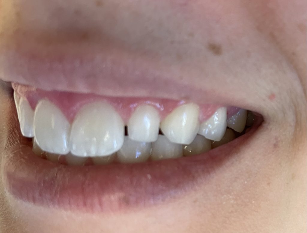 Before Dental Bonding