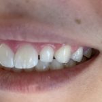 Before Dental Bonding